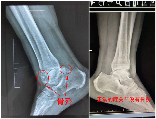 崴脚2.jpg